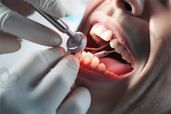 医保种植牙可以报销吗 种牙可以报医保吗