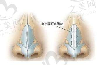 深圳李信锋做鼻子48000元贵吗?耳软骨隆鼻这价不贵,半肋鼻综合得要5万