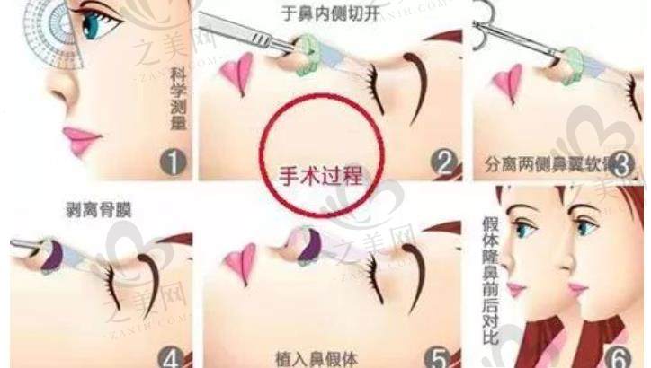 南京人气医生曹海峰做鼻子效果怎么样?隆鼻技术有保障,值得关注!