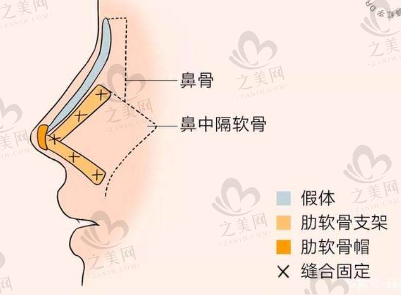 2025国内鼻整形修复厉害的医生大盘点:刘彦军等高难度修复强,范飞可线上预约,收费各不同