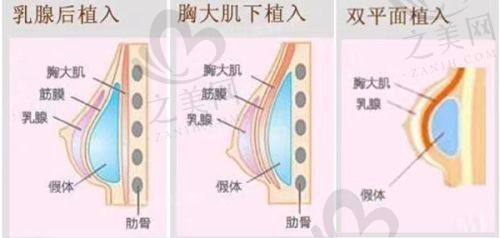 北京丰胸医生李朕隆胸实例