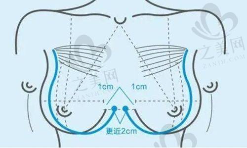 北医三院隆胸预约挂号