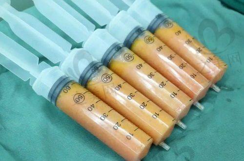手术过程体验