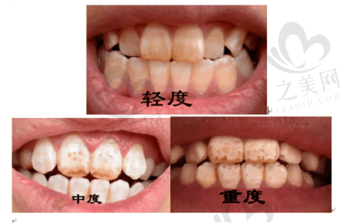 种植体来源与价格