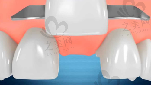沈阳种植体1855元/颗情况