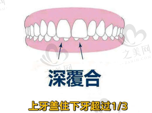 二、牙齿矫正项目