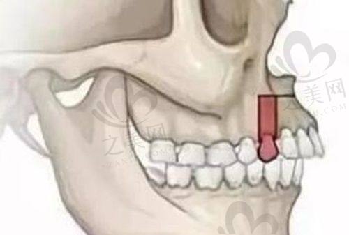 颌垫推簧矫治器的使用体验与成效