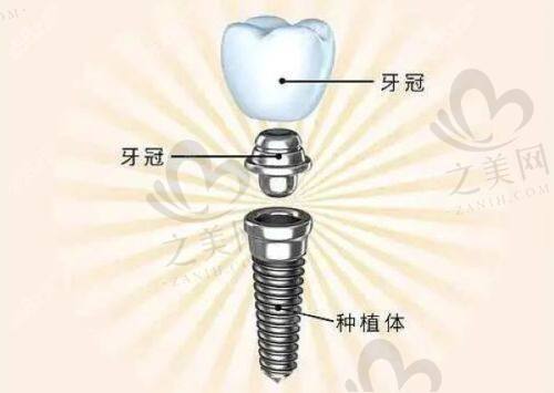 牙齿矫正优势之美学设计方案