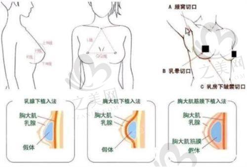 超光子治疗过程