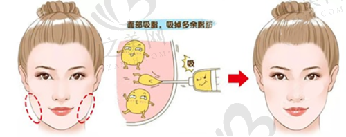 高尚医学美容中 心余文林做唇裂修复手术