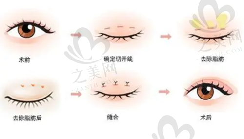 成都双眼皮修复骨干医生口碑评价