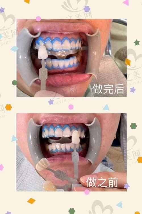 牙齿矫正情况