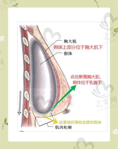 想在深圳隆胸的看过来,深圳艺星美容整形医院做隆胸到底好不好,实际情况告诉你