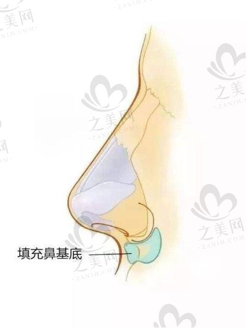 隆鼻整形医院的特色隆鼻技术有哪些