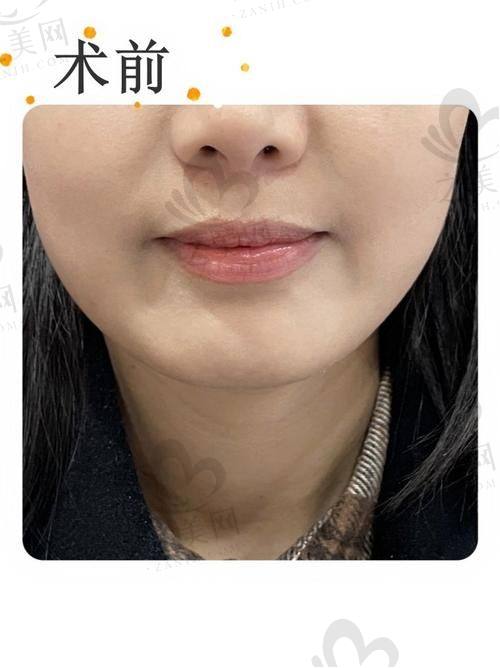 隆鼻整形医院的价格区间和收费标准