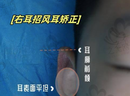 广州招风耳整形哪家好?广州高尚医疗美容门诊招风耳矫正体验分享,余文林术后改变超惊艳