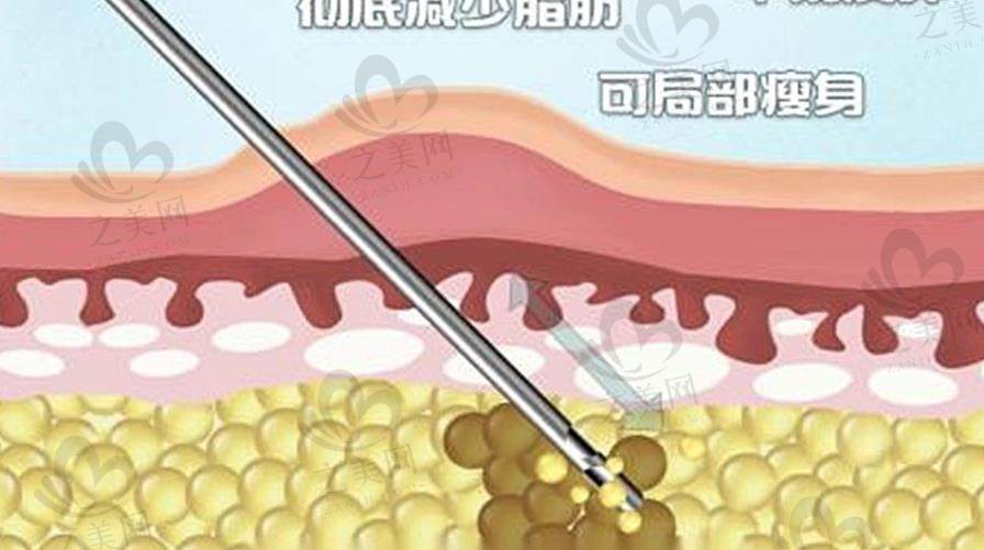 吸脂手术常见危害与严重后遗症大揭秘,含凹凸不平预防及感染、器官损伤应对办法