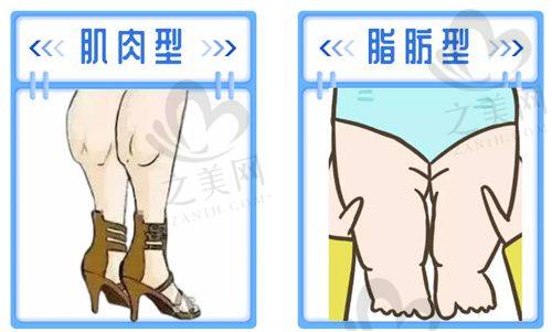 婕尔玻尿酸填充体验