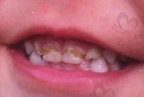 综合考虑选择广州合适的牙科医院