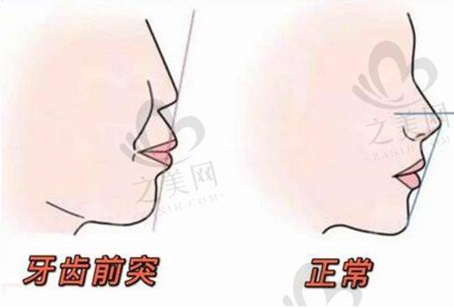 南京儿童牙齿矫正费用多少