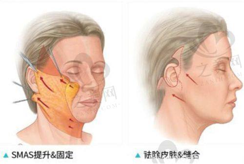 鼻子整形更好的医院的收费标准详情