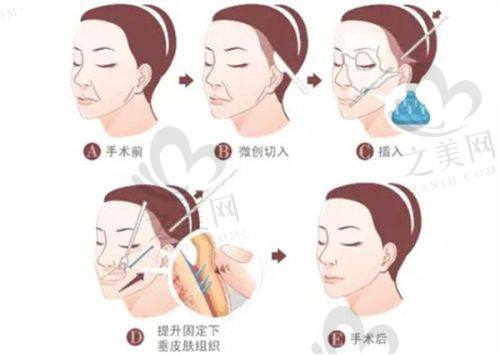 胸部整形三等甲医院的口碑评价