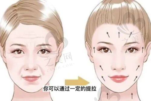 多次(30次)小气泡积极成效
