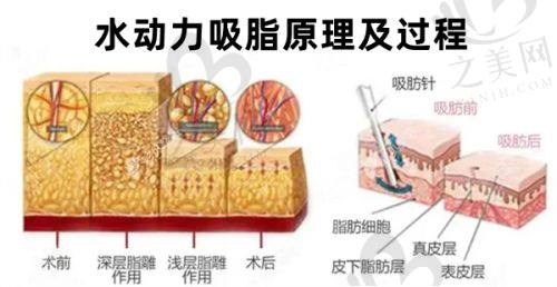 面部提升手术综合对比与选择建议