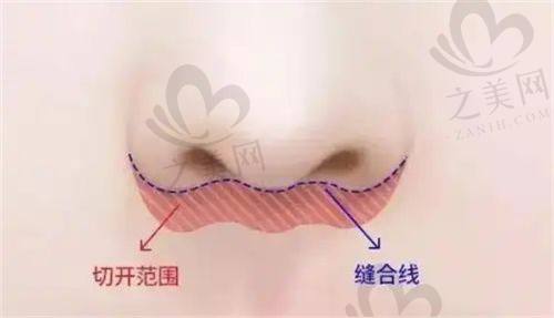 深圳福雅医疗胡俊杰医生人中缩短测评