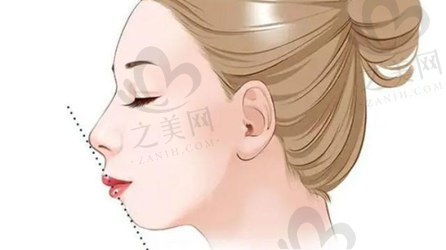 长沙美莱鼻综合的术后护理