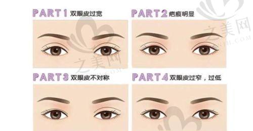 擅长眼部整形骨干医生的成功实例有哪些