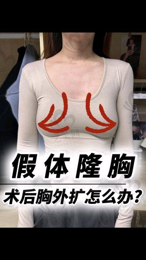 胸部整形好医生的收费标准