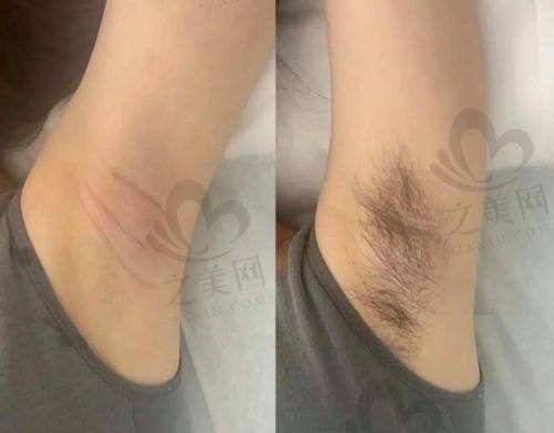 男士私密脱毛体验成效
