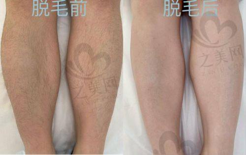 首次脱毛详细过程