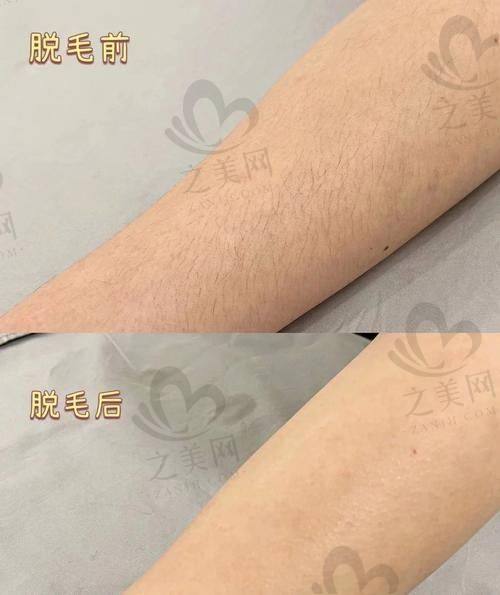 曲靖医美医院脱毛价格分析