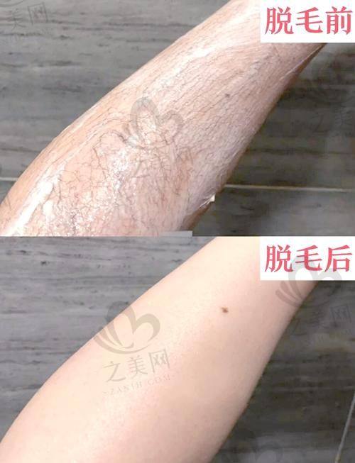 激光脱毛原理及疗程