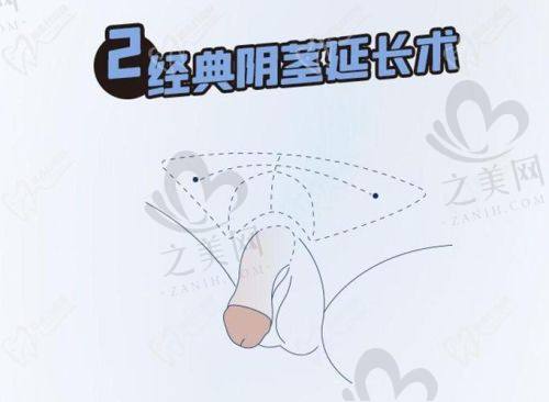 男科医生检查性功能的方法