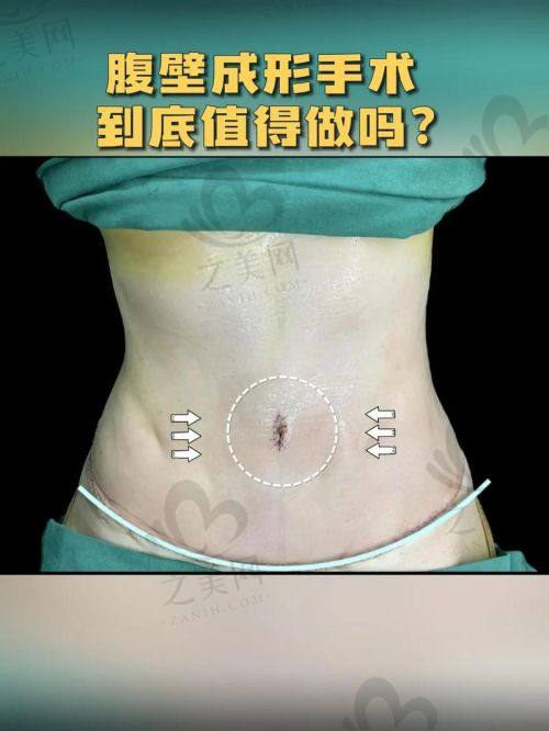 对后悔做腹壁整形原因的分析
