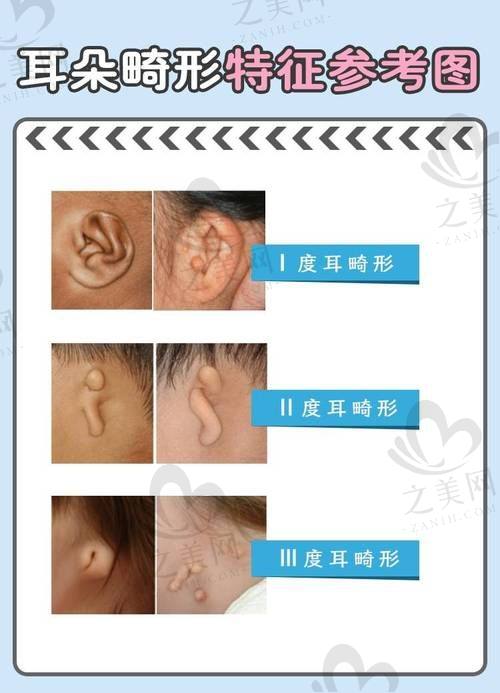 郑州大学第二附属医院耳朵整形成效