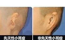 招风耳矫正手术成效与复发情况