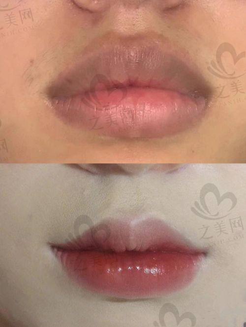 麻醉与术后护理费用