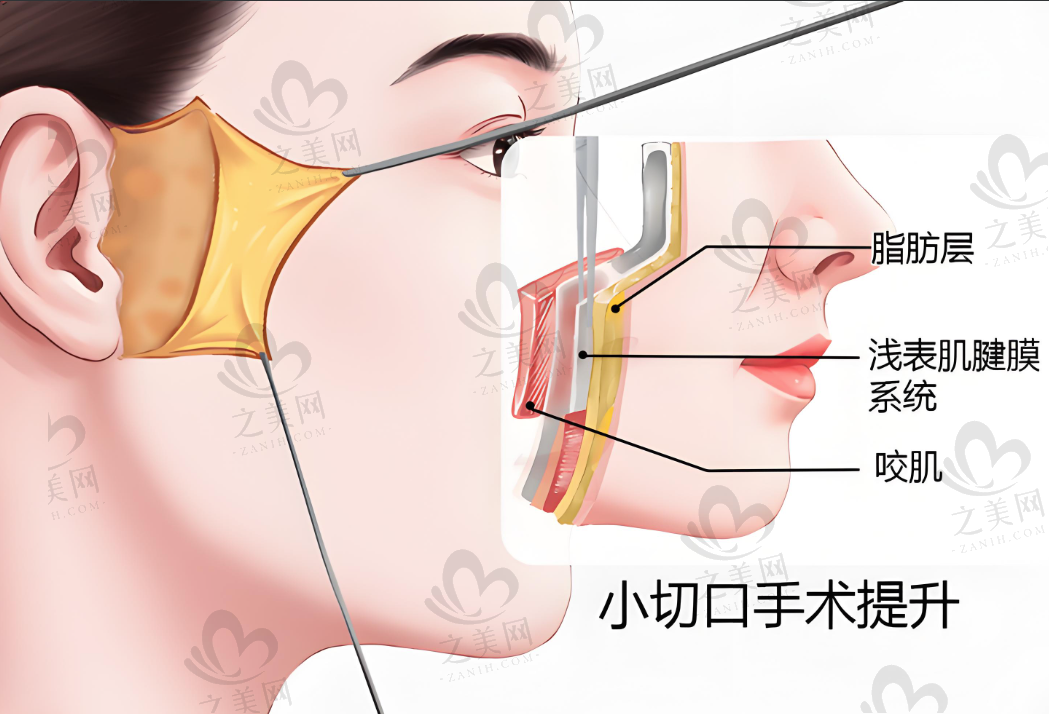 线雕、拉皮、光微提升等面部提升手术大对比,从维持时长到并发症,教你选适合自己的!