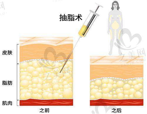 冯斌高价整形原因剖析