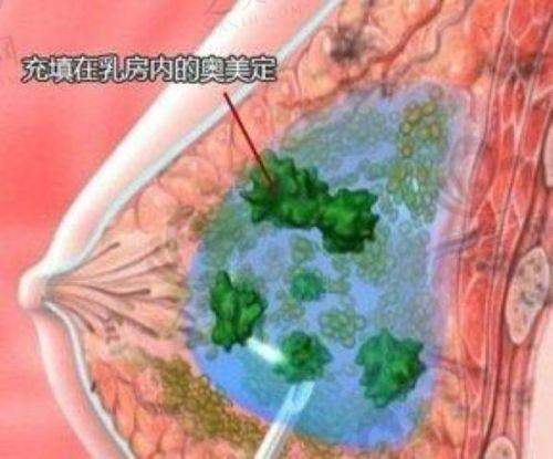 北京新兴医院：微创异物取出典范