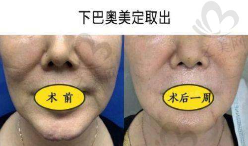 北京异物取出干净的医院名单