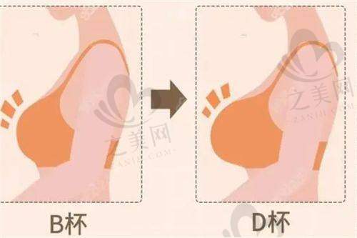 杭州维多利亚整形口腔医院刘中策快乐丰胸、巨乳缩小、乳房下垂矫正 2980 元起,三种切口分型定制重塑美胸