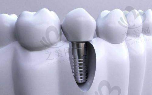 福州登特口腔医院收费贵吗