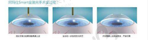 近视手术优惠亮点