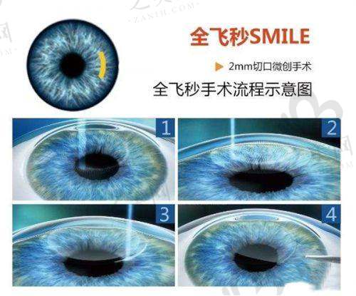 乌鲁木齐普瑞眼科医院近视手术价格
