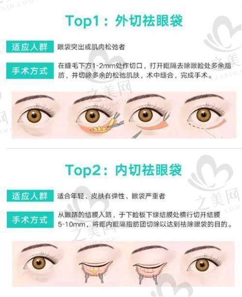 眼整形更好的医院成功实例展示
